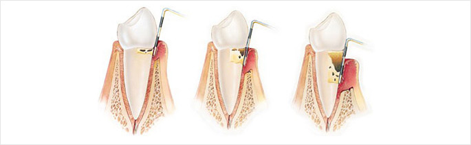 牙周炎治疗后会复发吗？